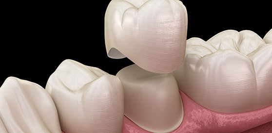 3D render of a dental crown