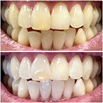 Smile before and after receiving dental treatment