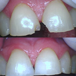 Smile before and after receiving dental treatment