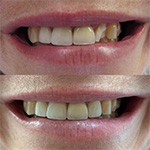 Smile before and after receiving dental treatment