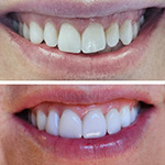 Smile before and after receiving dental treatment