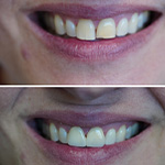 Smile before and after receiving dental treatment