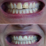 Smile before and after receiving dental treatment