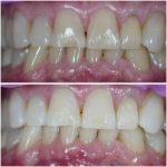 Smile before and after receiving dental treatment
