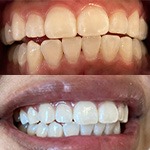 Smile before and after receiving dental treatment