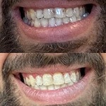 Smile before and after receiving dental treatment