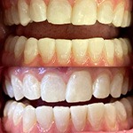 Smile before and after receiving dental treatment