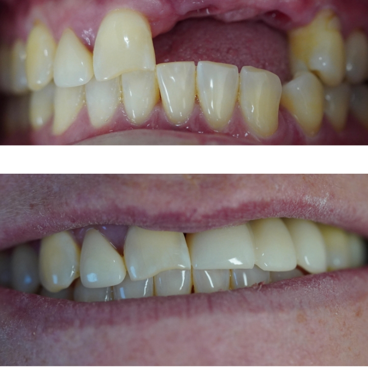 Smile before and after dental work