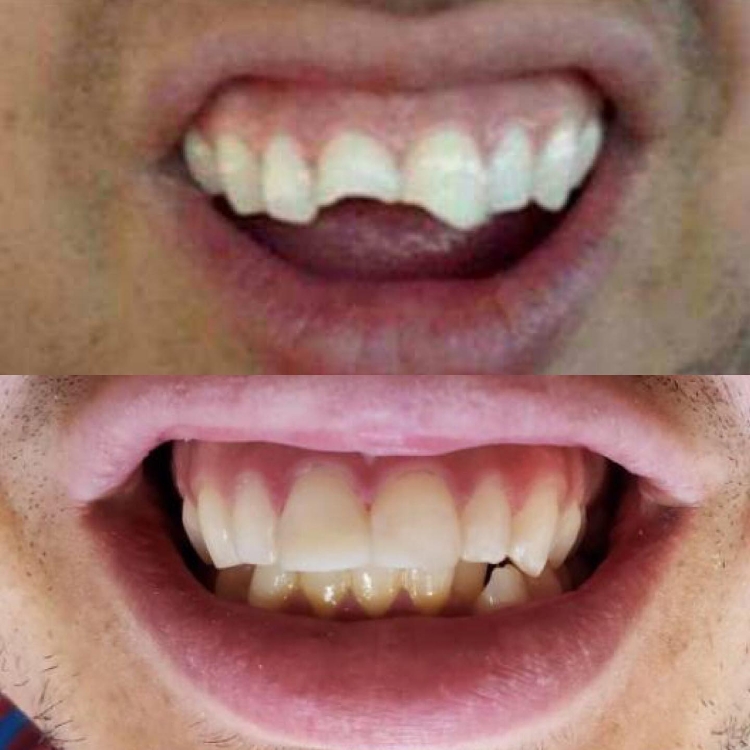 Smile before and after receiving dental treatment