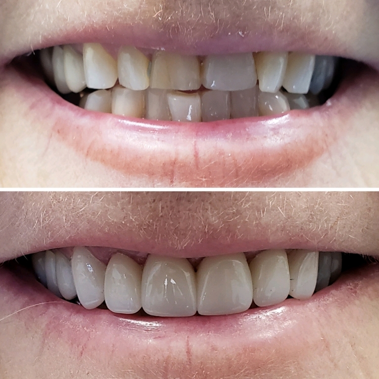 Smile before and after receiving dental treatment