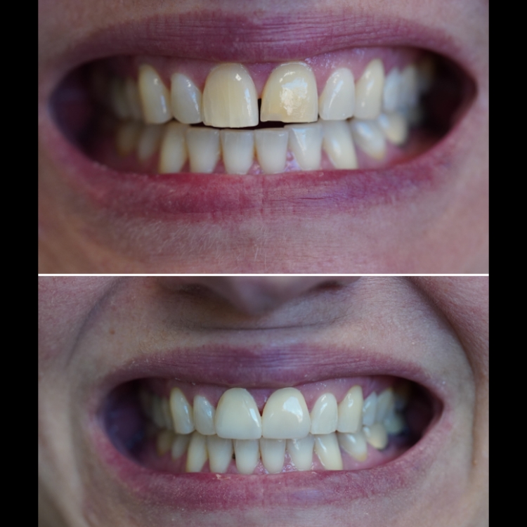 Smile before and after receiving dental treatment