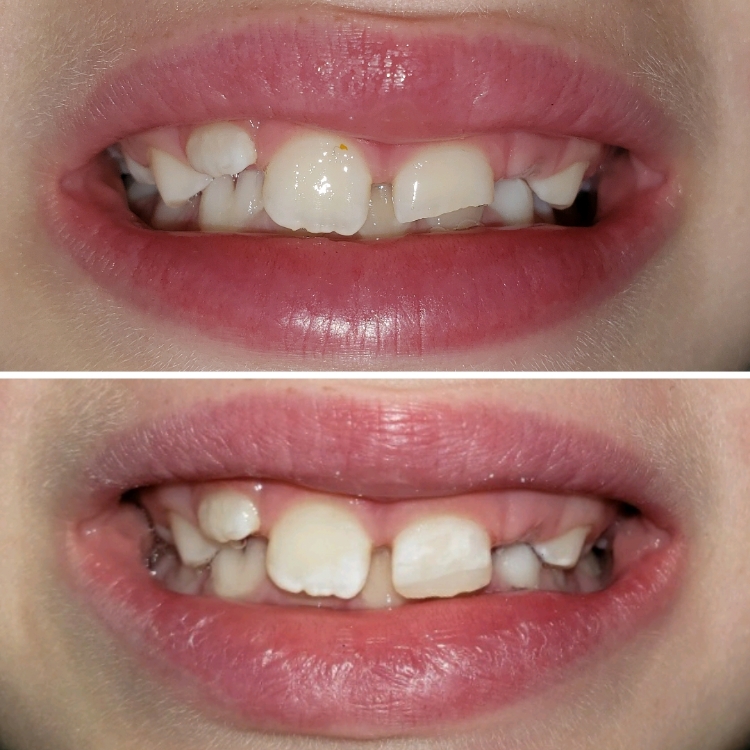 Close up of smile before and after dental treatment