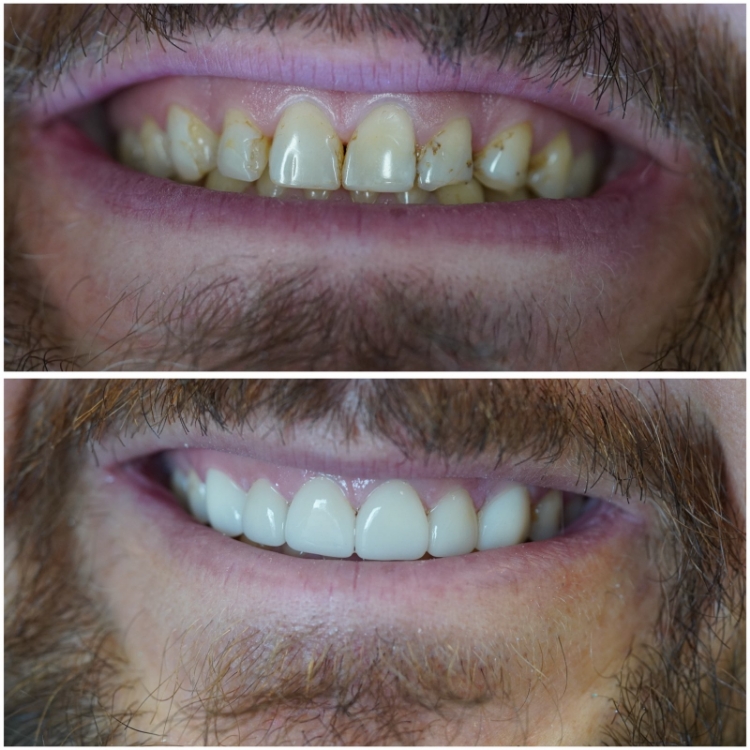 Smile before and after treatment