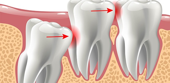 Picture of an impacted tooth